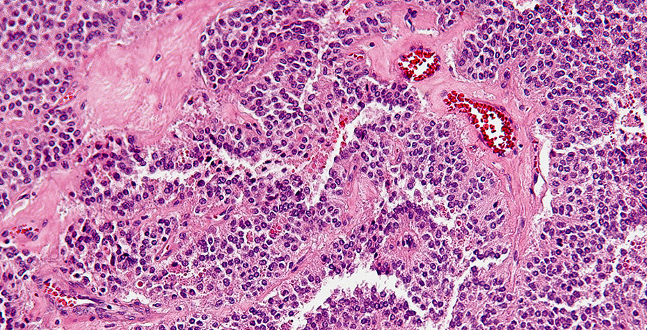 highly magnified pancreatic tumor cells, stained pink